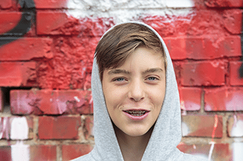 types of braces long hill nj