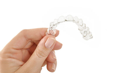 How Do I Clean My Invisalign Aligners?