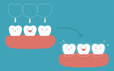 Before You Choose Invisalign, Read This