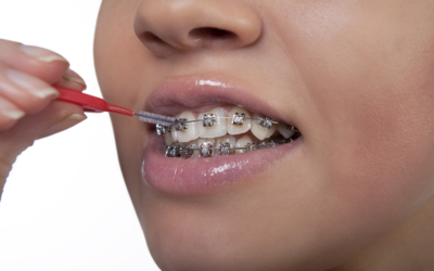 How Do I Floss with Braces?