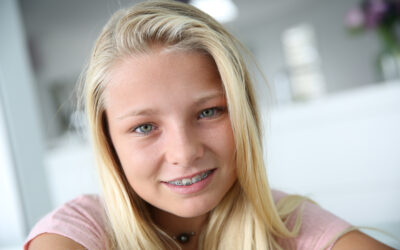 Tips on How to Keep Your Braces Sparkling Clean