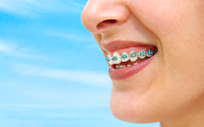 What Color Braces Should I Get Next?