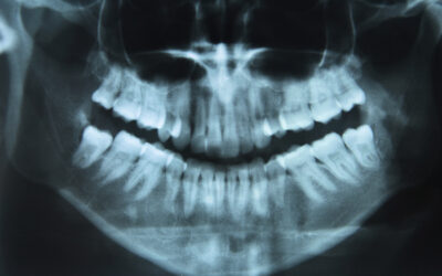 What Causes Crooked Teeth?