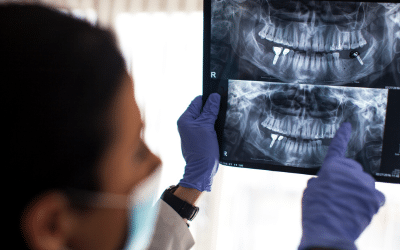Can Invisalign Fix Overbite? Demystifying Overbite Correction