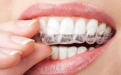 Invisalign is Modern Day Approach to Braces