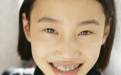 What You Need to Know Before Choosing Braces