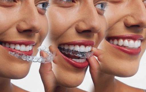 Average Cost Of Invisalign - Wayne NJ - Smiles By Lorino