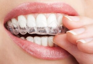 Invisalign for Adults