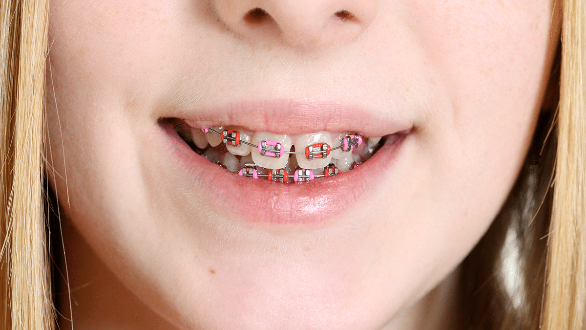 braces treatment timeline