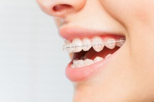 Close up of a woman wearing clear braces from her orthodontist in New Jersey
