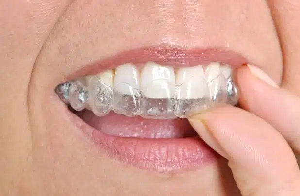Am I A Good Candidate For Invisalign