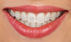 Clear (Ceramic) Braces