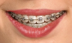 how long your braces treatment can take