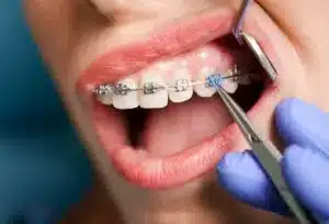 braces