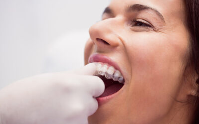 What is the Average Cost of Invisalign?