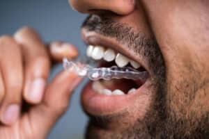Invisalign-friendly foods