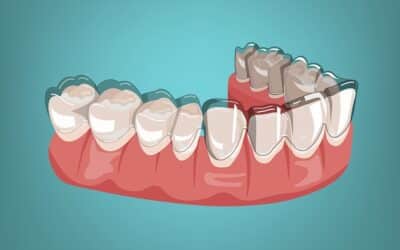 The Role of Invisalign in Alleviating TMJ Symptoms