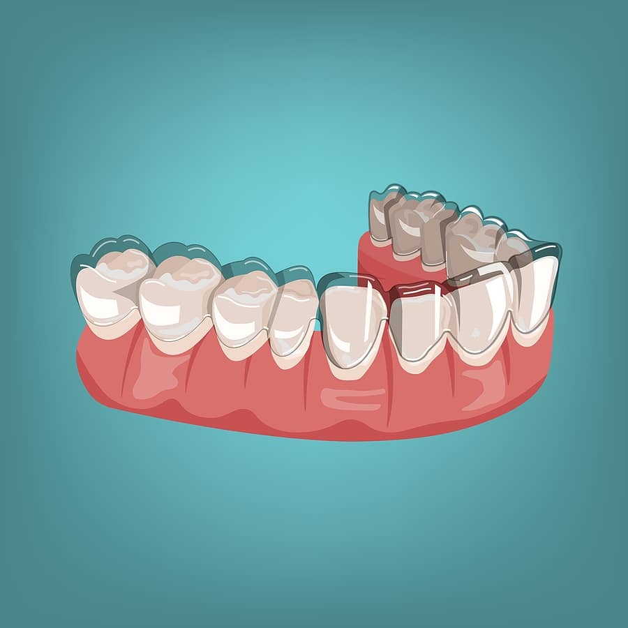 can Invisalign fix overbite