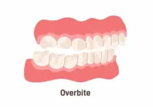 can Invisalign fix overbite