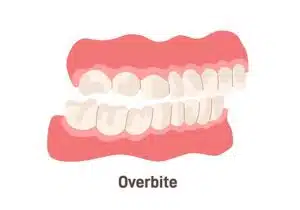 can Invisalign fix overbite