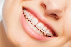 braces in New Jersey