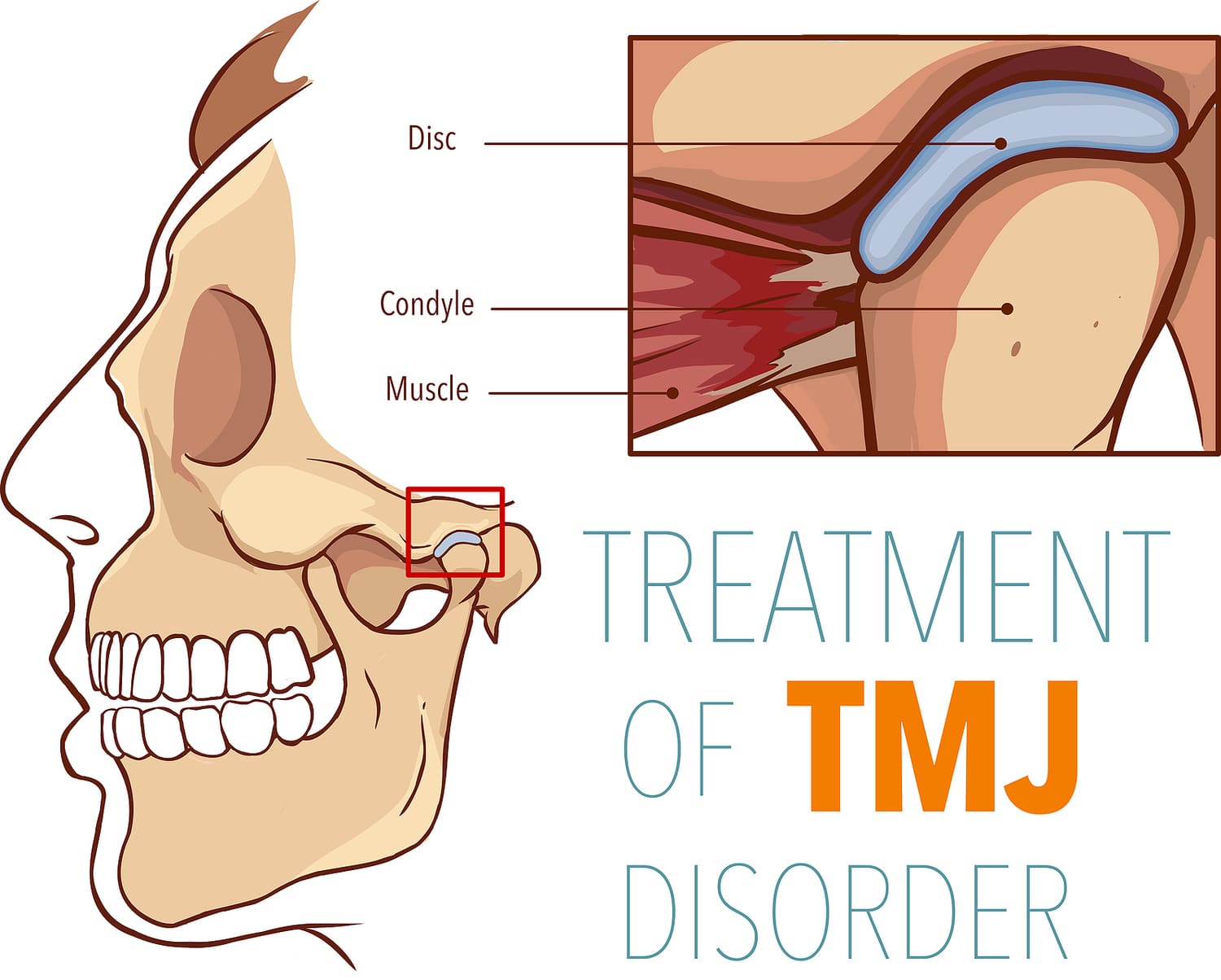Does TMJ pain go away naturally? Illustration