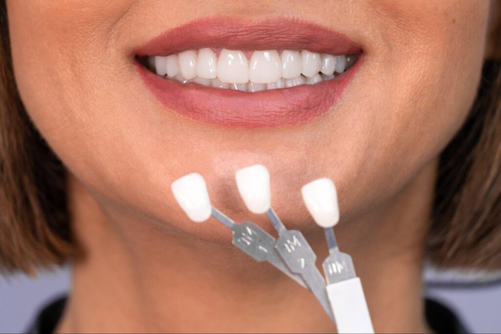 Close-up of a bright smile next to professional whitening shade samples